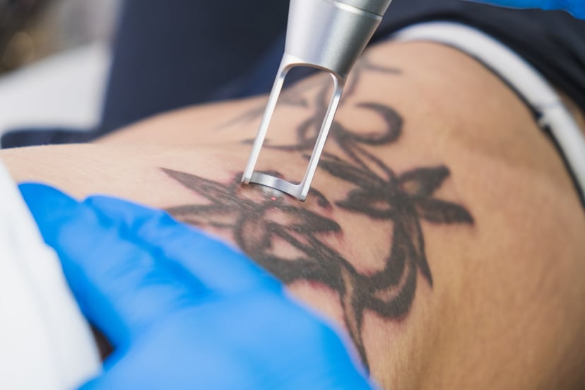 Professional removing tattoo by laser inside a clinic