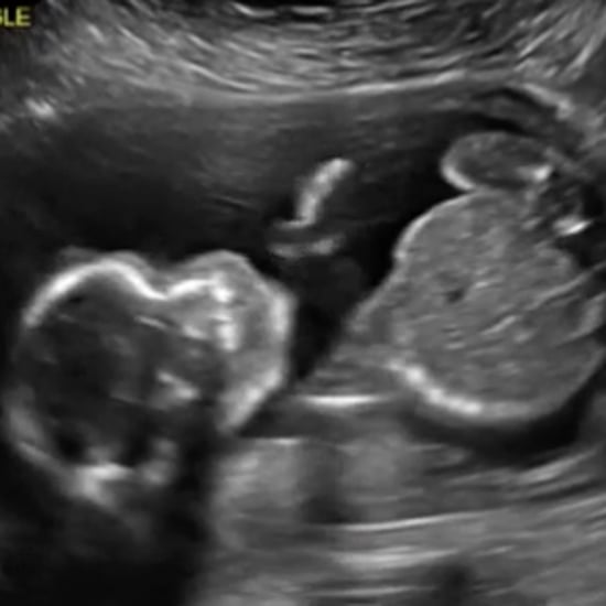 Baby Punching Himself During an Ultrasound