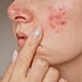 A Guide to Rosacea Symptoms, Triggers, and Treatments