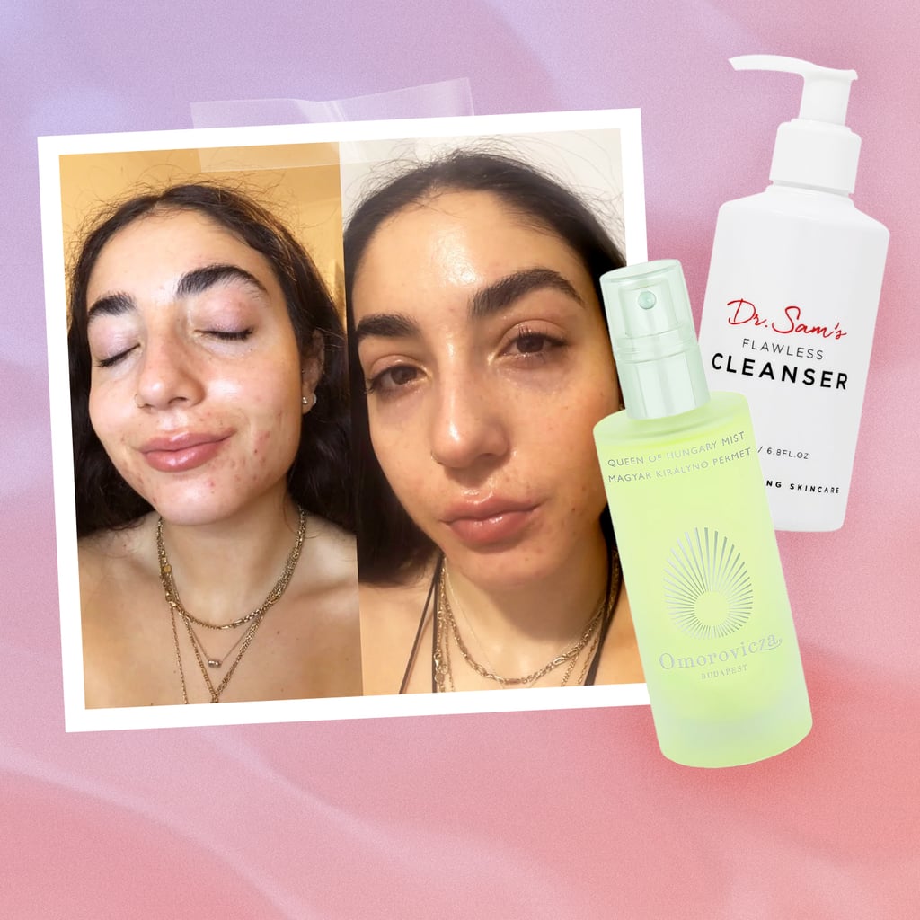 I'm on Accutane, and These Products Solved All My Dry Skin Problems