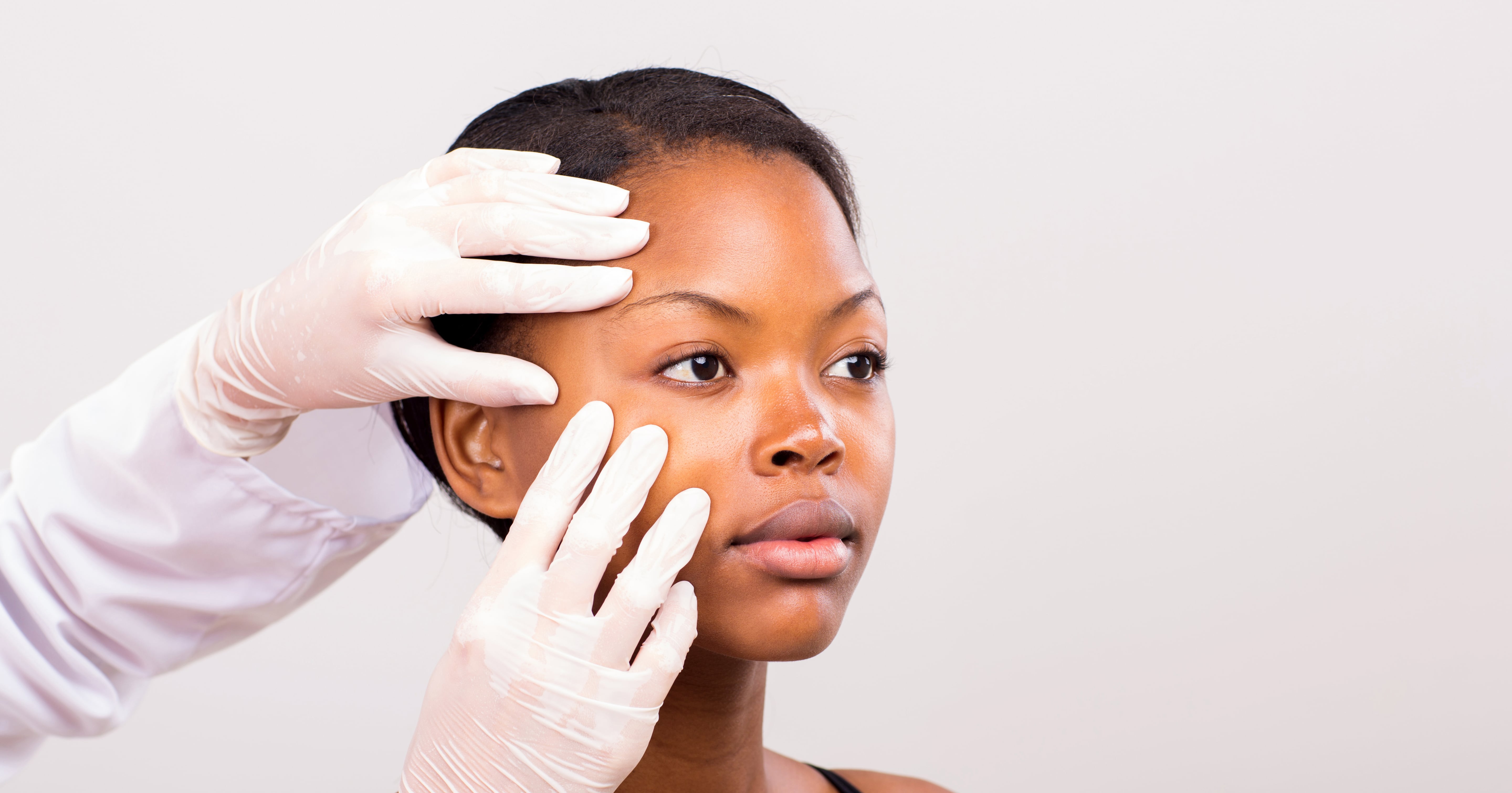 Dermatosis Papulosa Nigra, as Explained by a Dermatologist
