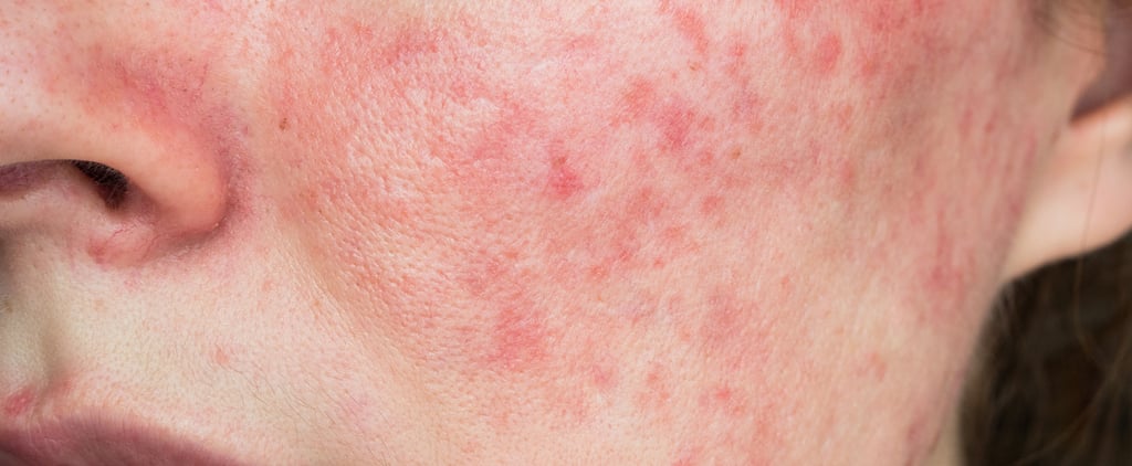 Rosacea Skin-Care Routine, According to Dermatologists