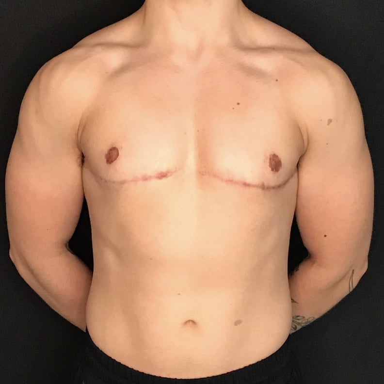 Double Incision Top Surgery