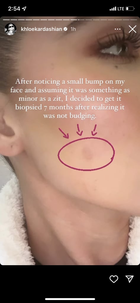 Khloé Kardashian Had a Tumour Removed From Her Face