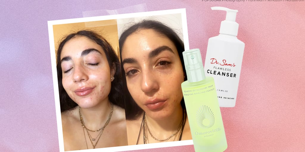 I’m on Accutane, and These Products Solved All My Dry Skin Problems