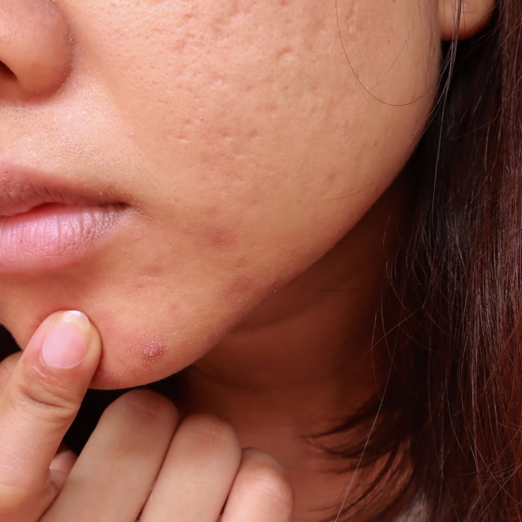 What to Know About Treating Cystic Acne, Per Dermatologists