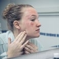 Dermatologists Explain How to Treat Facial Eczema and Prevent Flare-Ups