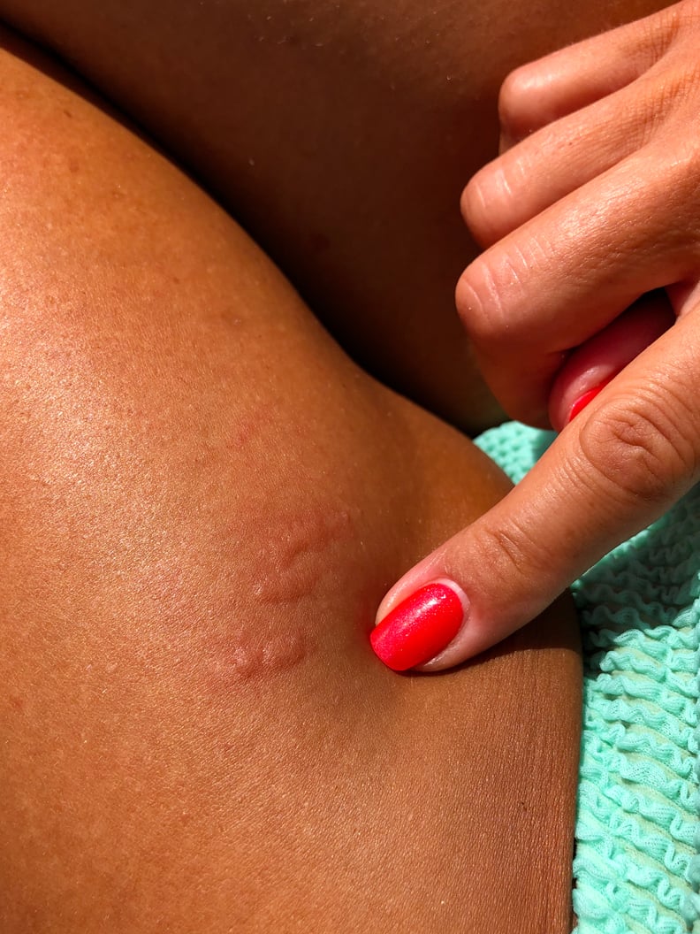 Painful Jellyfish sting rash on woman's leg