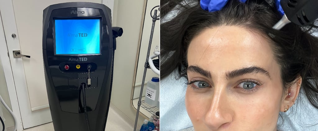 Alma TED Hair Treatment Review and Photos