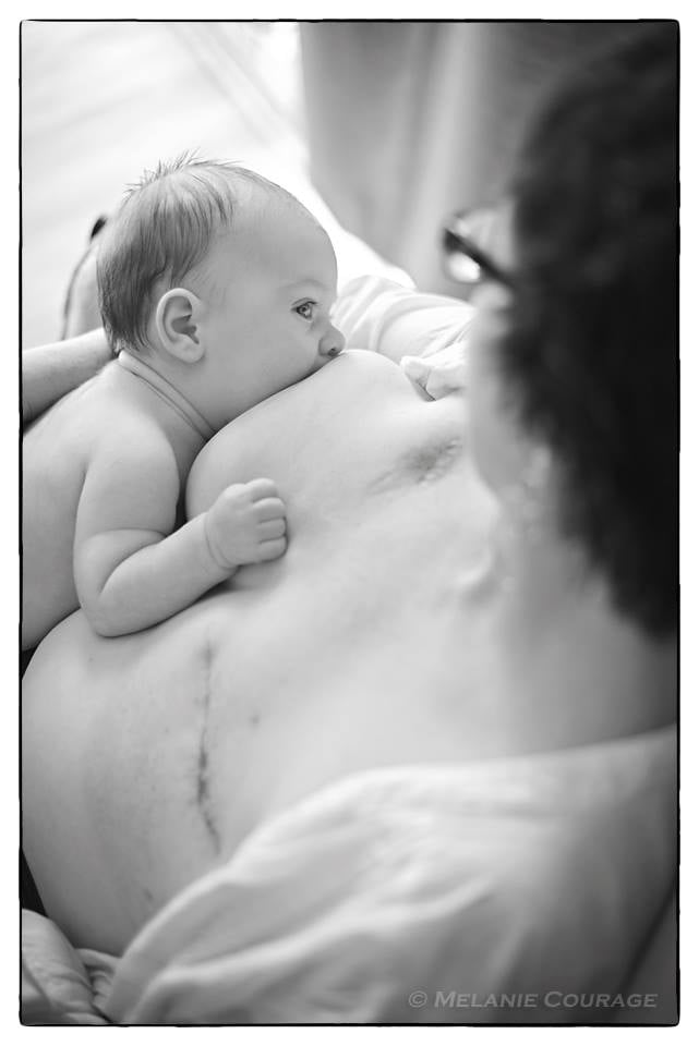 Mom Breastfeeding After Mastectomy