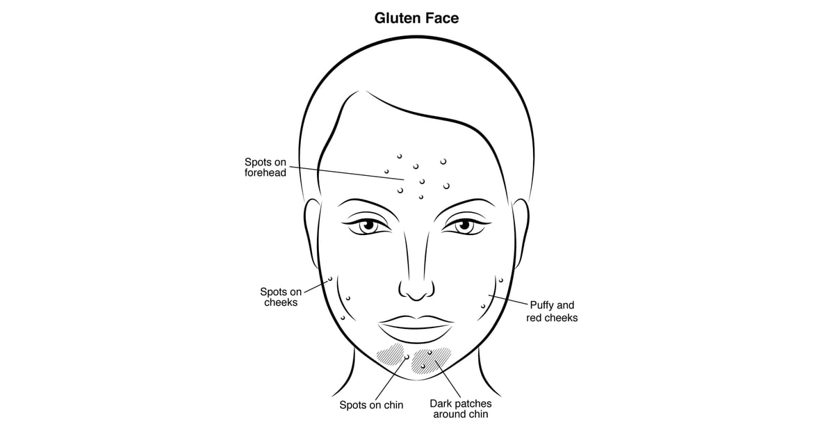 Gluten Face Gut Health and Skin Problems POPSUGAR Beauty Photo 3