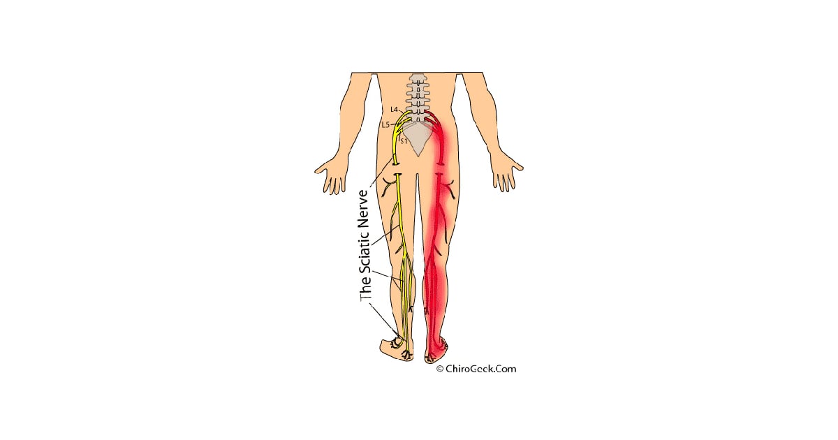 What's the Deal With Sciatica POPSUGAR Fitness