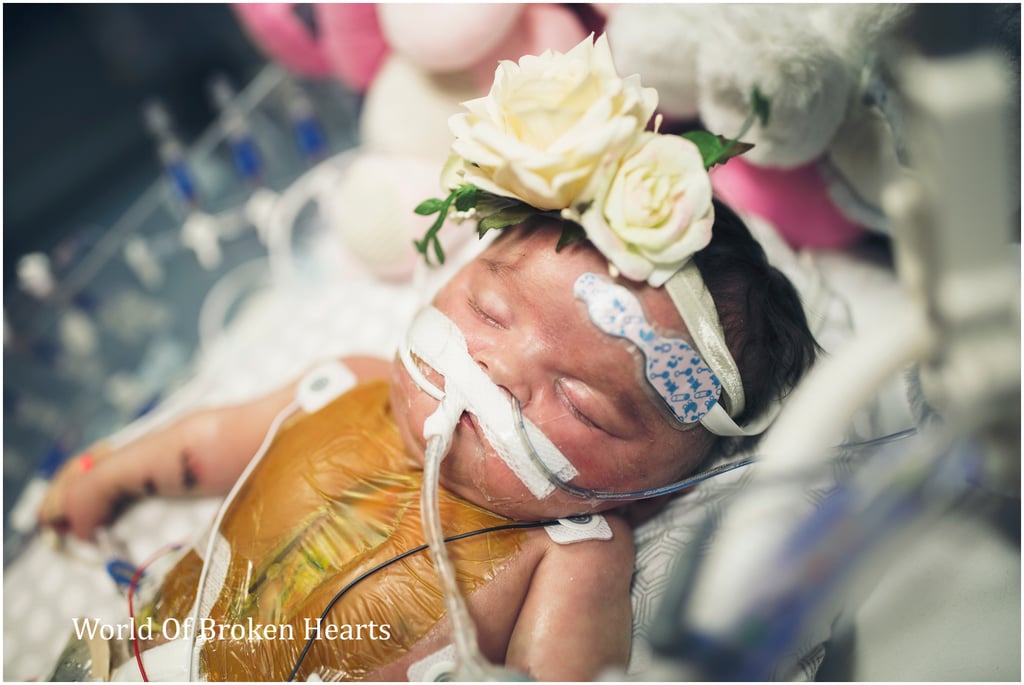 Twin With Heart Defect