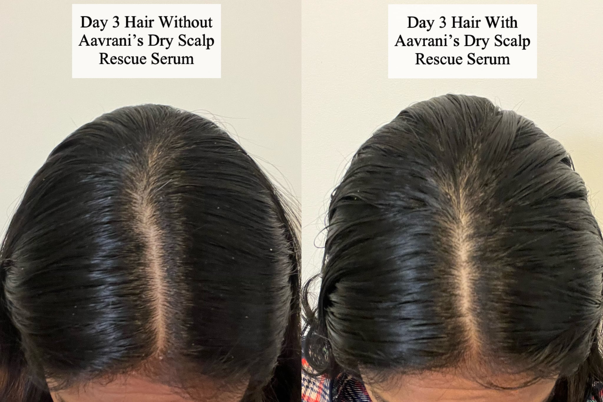 Before and after using the Aavrani Anti-Dandruff Dry Scalp Rescue Serum.