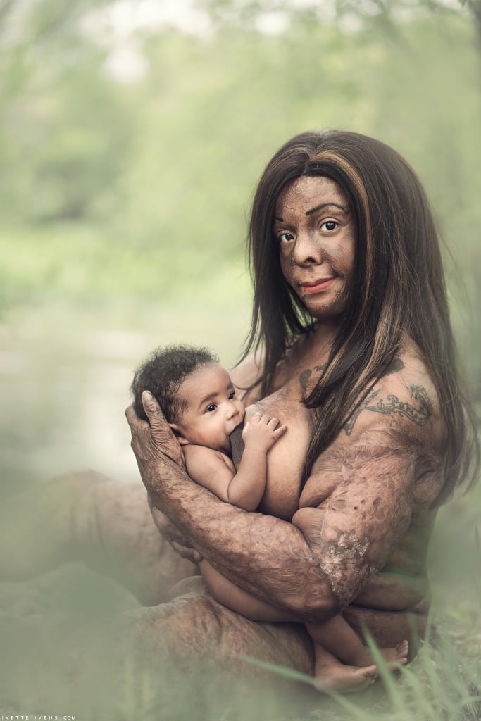 Burn Survivor Breastfeeding