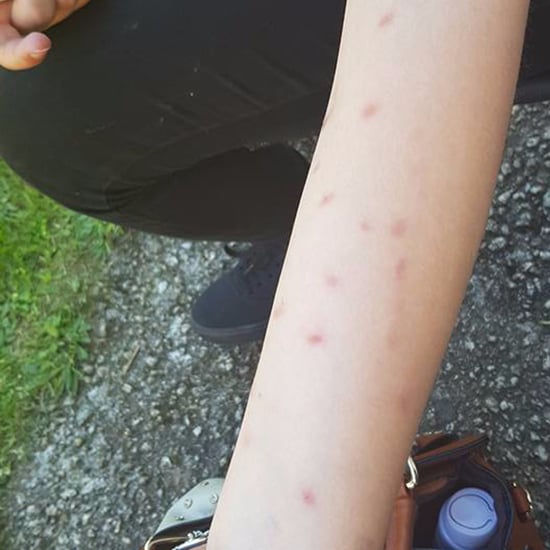 Kids Getting Burned From the Deodorant Challenge