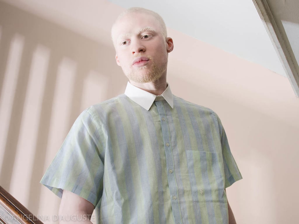 Albinism Photographs