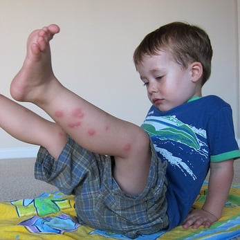 Home Remedies For Bug Bites and Stings