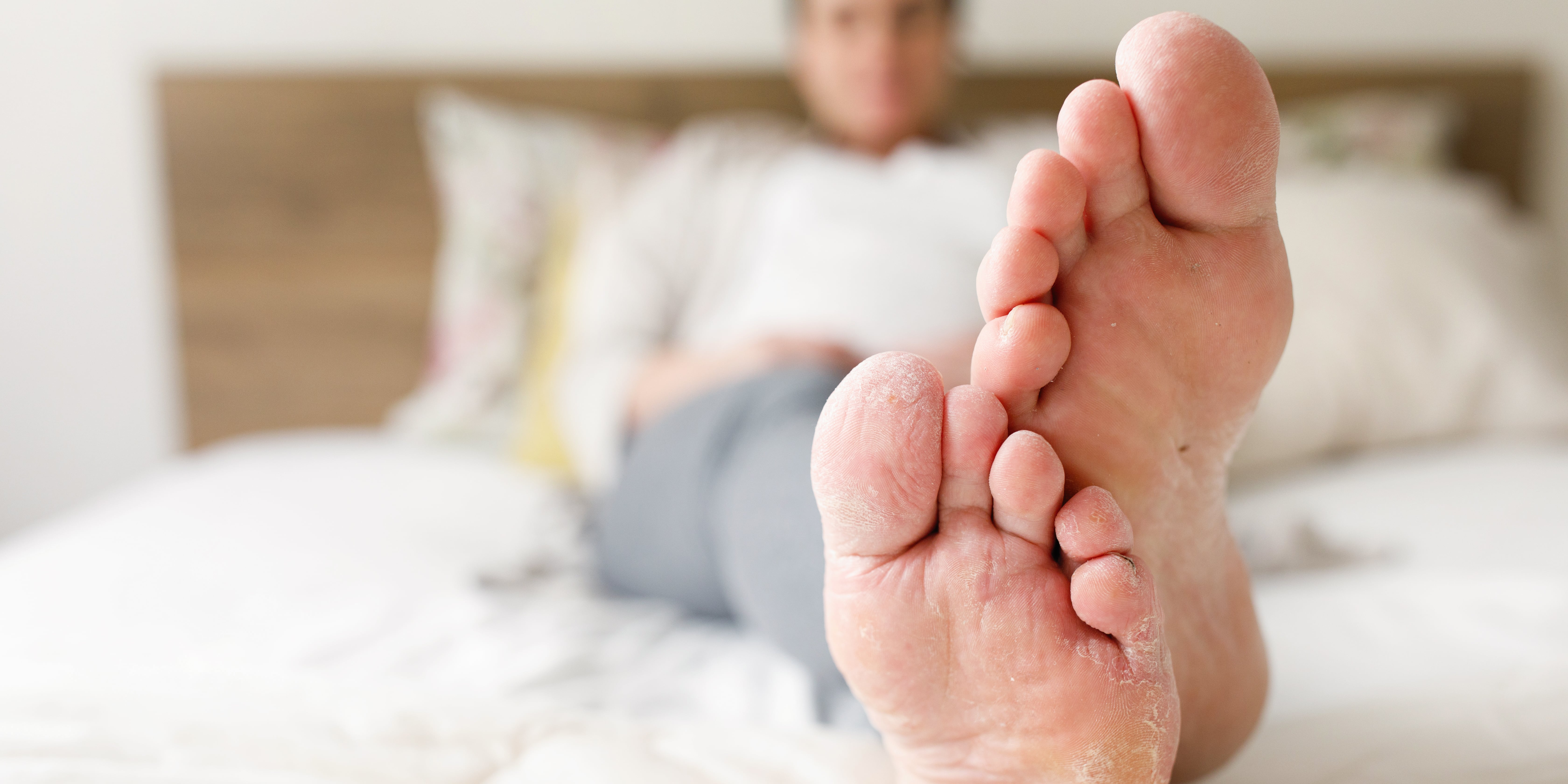 Why Are My Feet Peeling? POPSUGAR Fitness