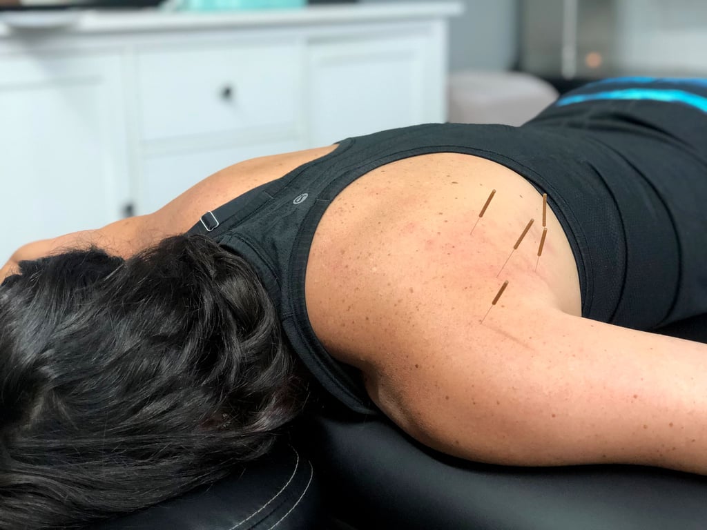 What's It Like to Get Dry Needling, and Does It Hurt?