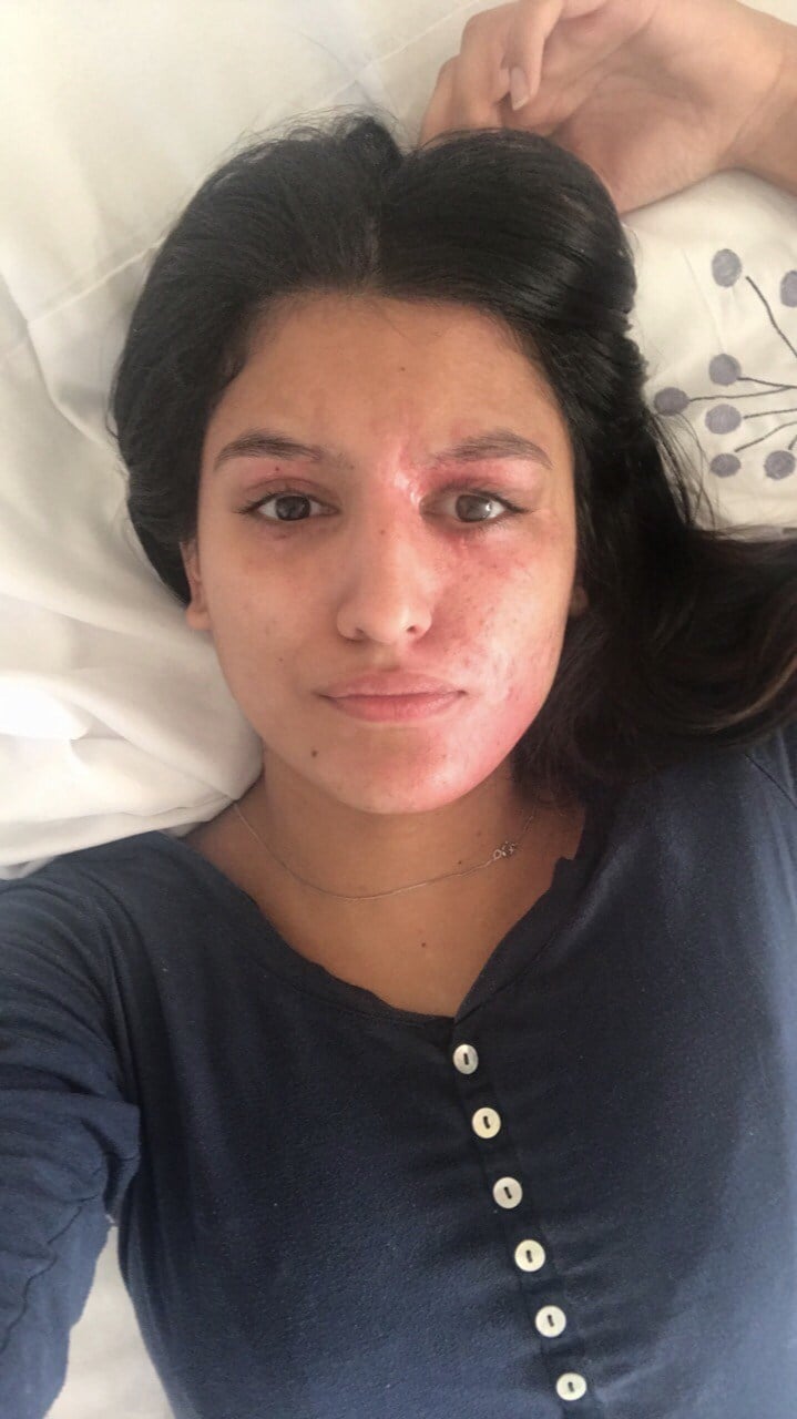 Resham Khan Acid Burn Victim Takes Makeup Free Selfie Popsugar Beauty