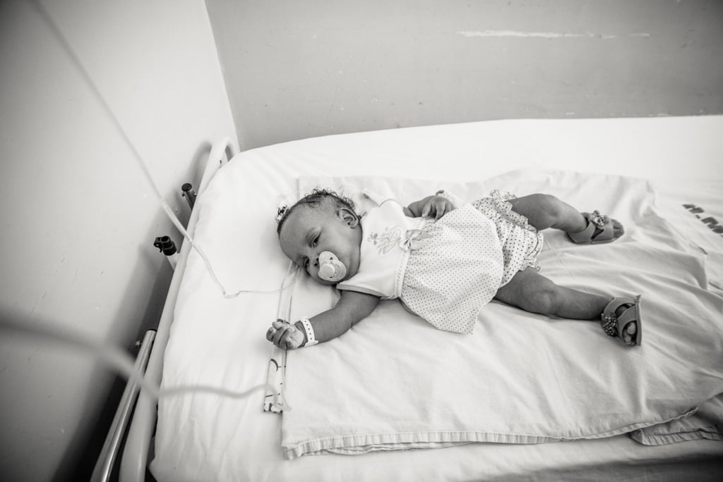 Conjoined Twins Are Separated and Photographed