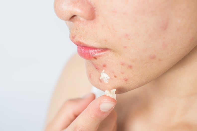 Common Skin-Care Mistake #6: Overdoing It With Spot Treatments