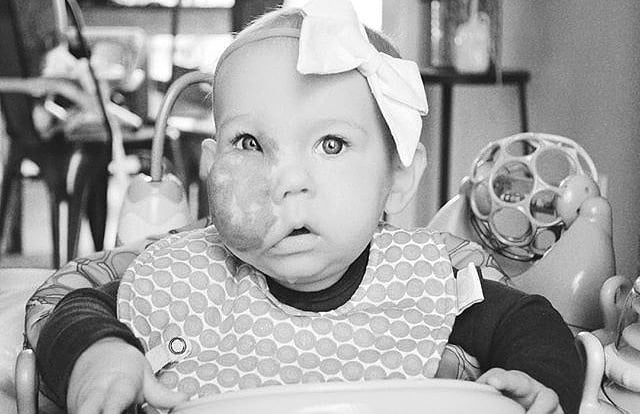 Baby With Capillary Hemangioma on Her Face