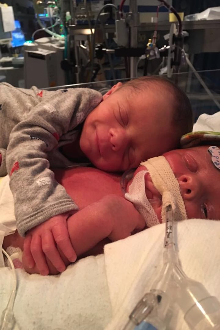 The twins who were hugging before one died