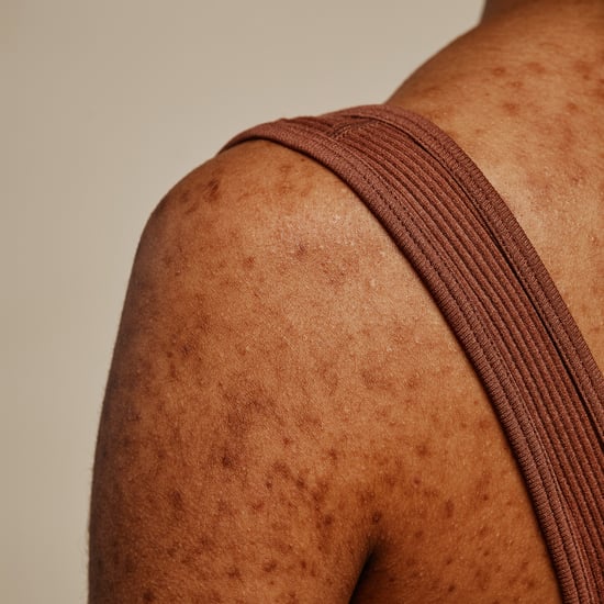 Hidradenitis Suppurativa on Black Skin: Causes and Effects