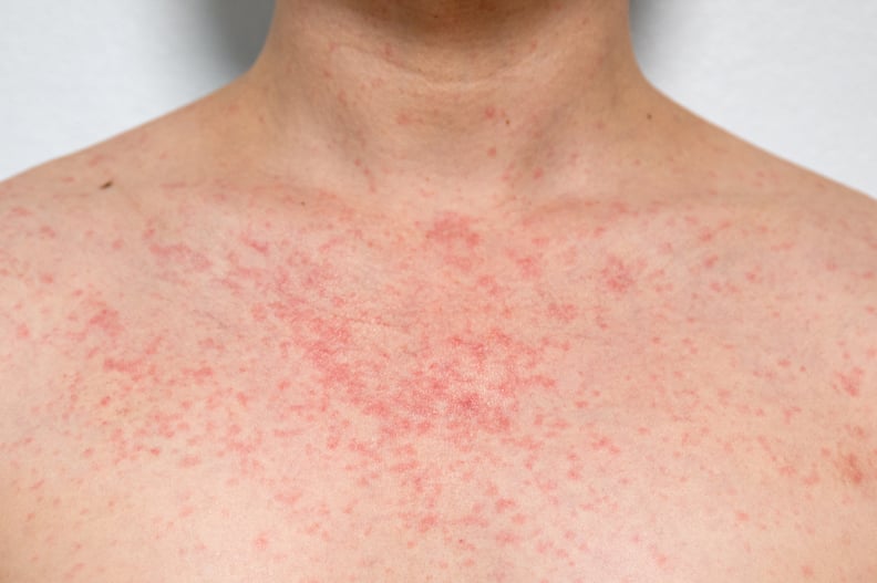 heat rash symptoms 