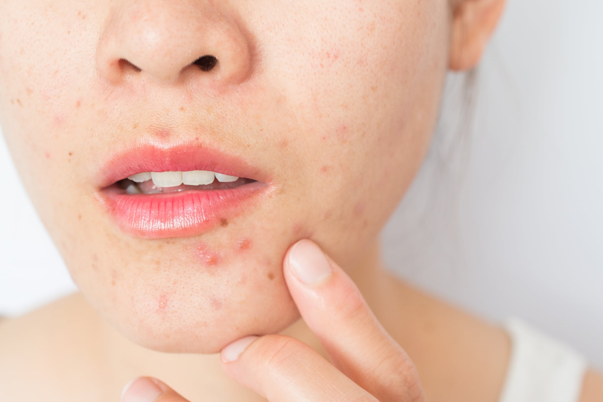 perioral dermatitis
