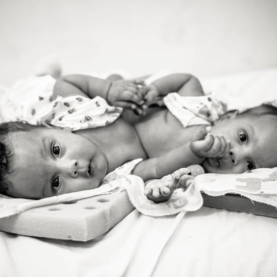 Photographer Captures the Beauty of Conjoined Twins