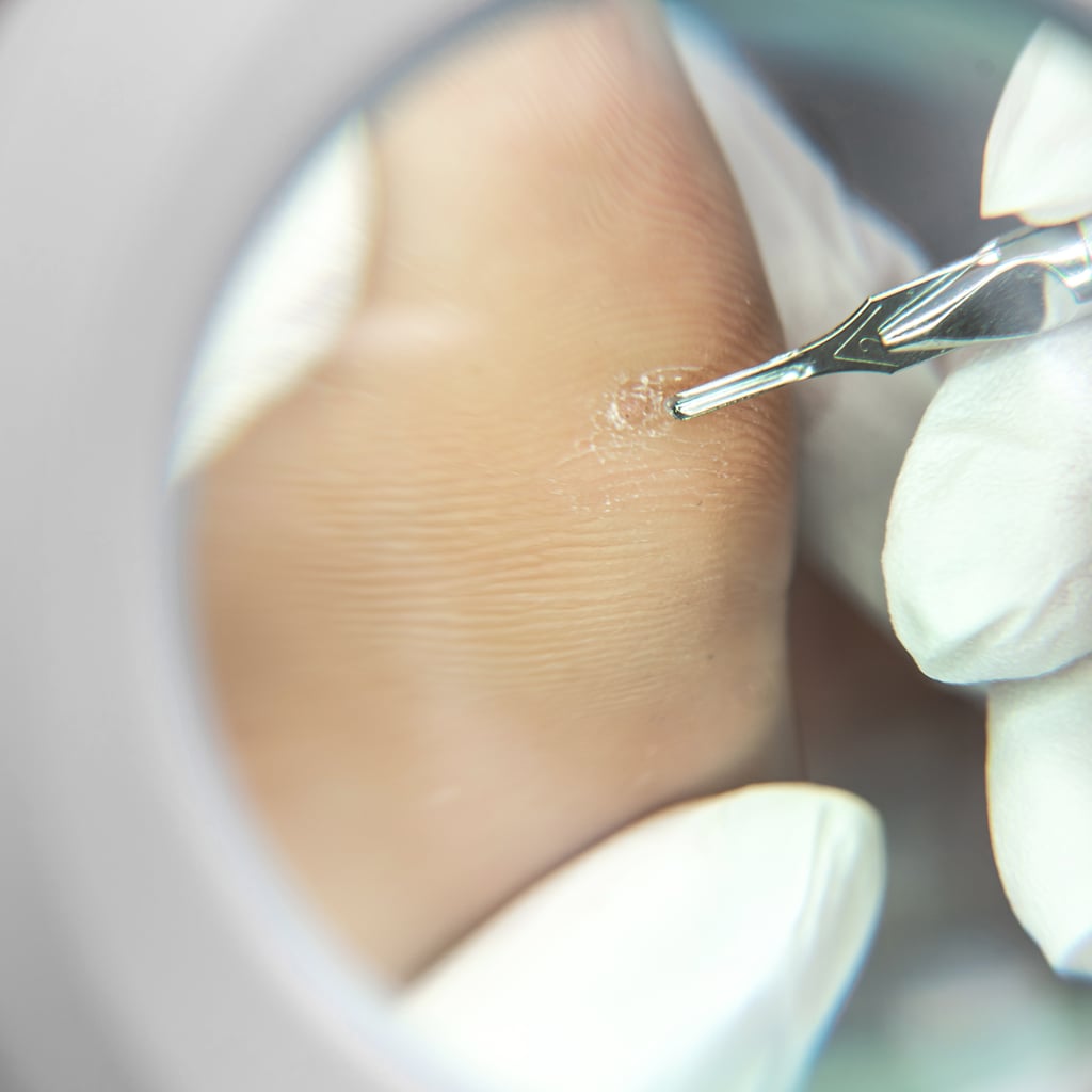 How to Identify and Treat Warts, According to Doctors