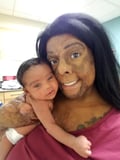 Incredible Story Behind Burn Survivor's