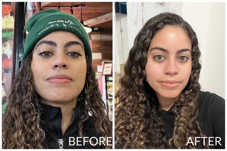 Why I Got Botox For My