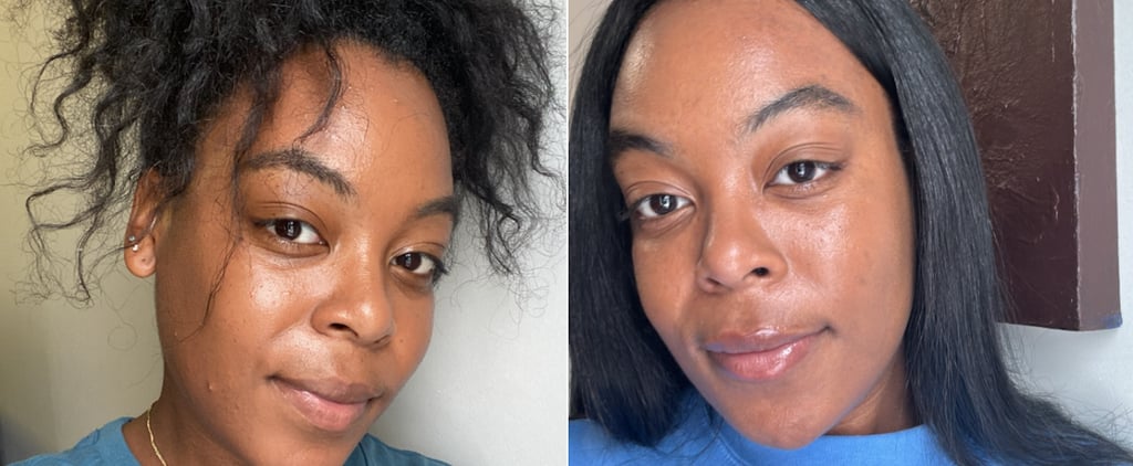 Winlevi Before and After: My Experience With the Acne Cream