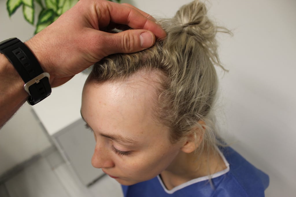 Diva Hollands's Hairline Before Surgery