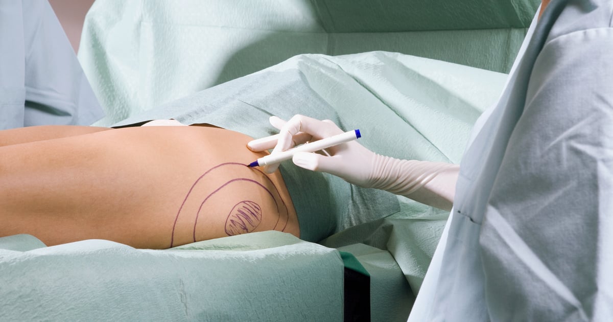 What Exactly Is a Brazilian Butt Lift and Why Is Everyone Talking About Them?