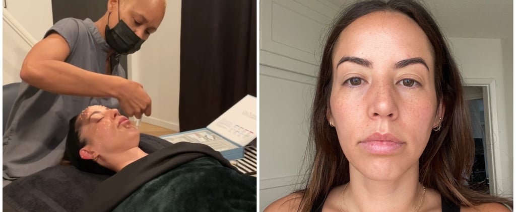 I Tried a Liquid Microneedling Treatment: See Photos