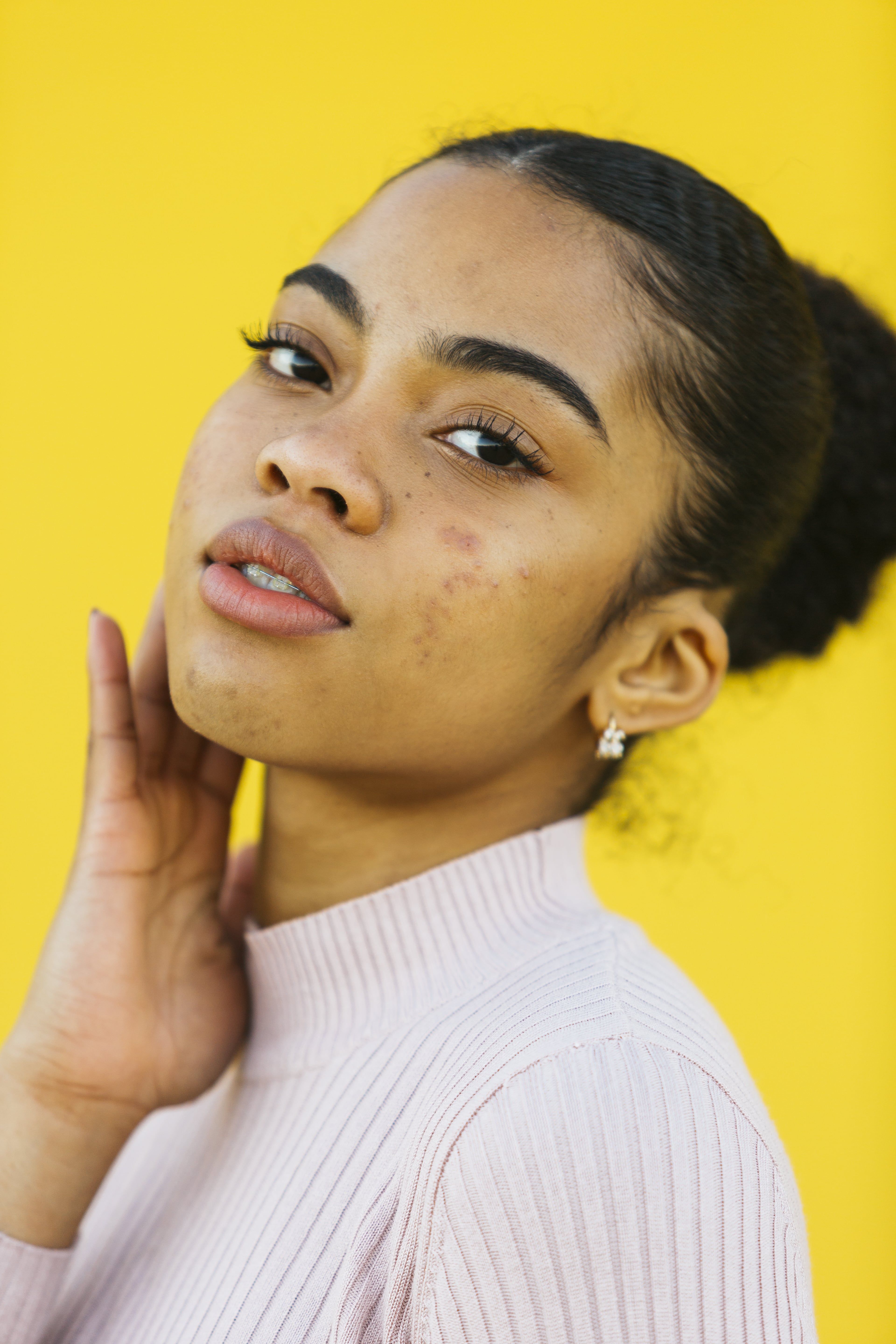 Acne Face Mapping: What Breakouts on the Face Mean