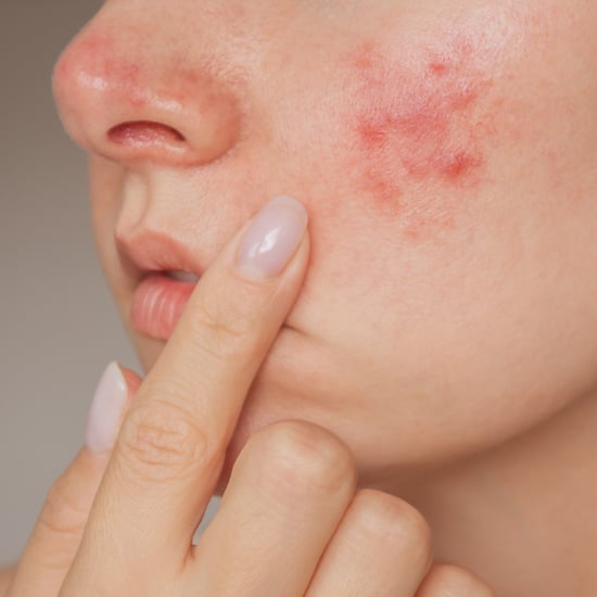 A Guide to Rosacea Symptoms, Triggers, and Treatments