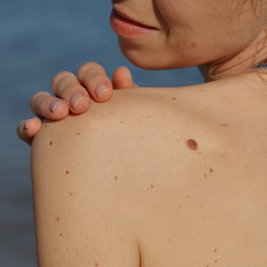 Melanoma: What It Looks Like, Risks, Symptoms, and More