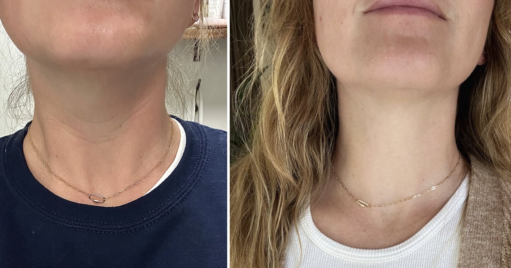 I Got Neck Botox to Treat My Tech Neck Wrinkles — and It Worked