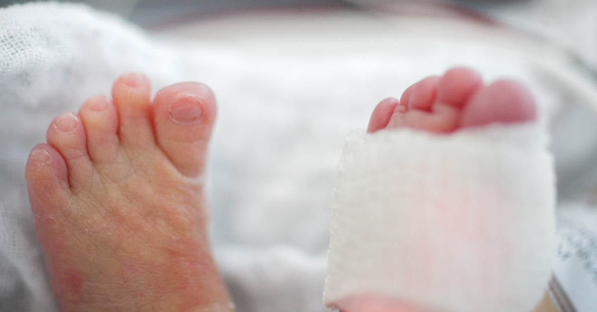 How to Get Rid of Hair Tourniquets From Baby Toes POPSUGAR Family