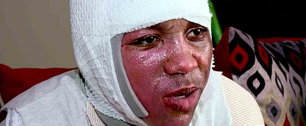 Teen Gets Burned From Doing the Hot Water Challenge