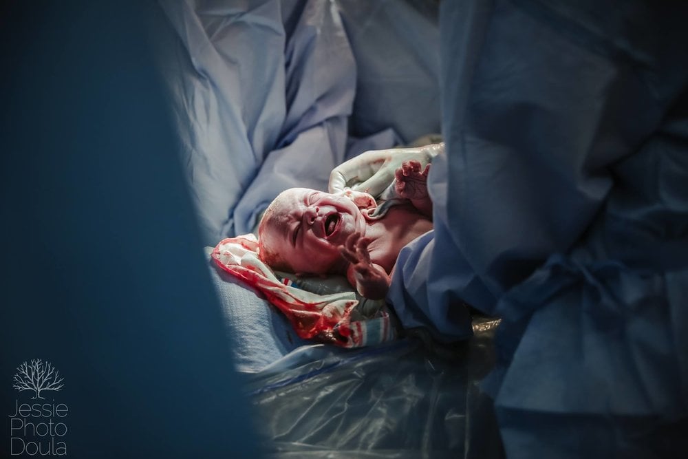C-Section Birth Photography