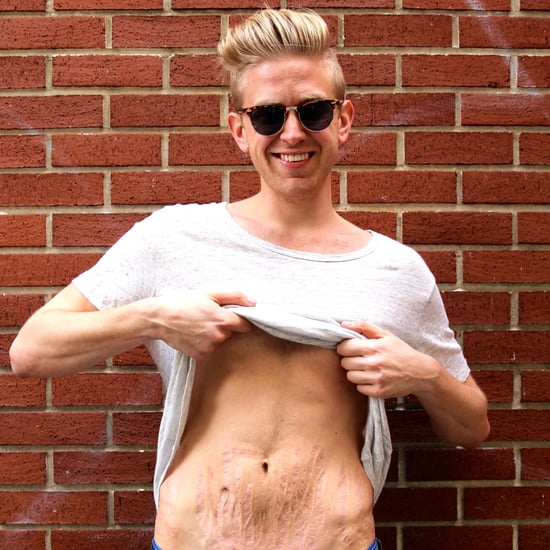 How to Love Your Stretch Marks