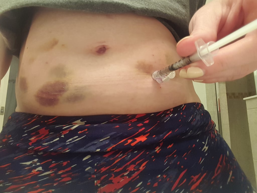 "My bruised belly from my cocktail of medications needed to bring home a healthy, happy baby! Injections happen everywhere. This was from our vacation to Florida but I've taken injections anywhere from Kauffman stadium (home of the KC Royals) to airport bathrooms. When it's time, it's time."