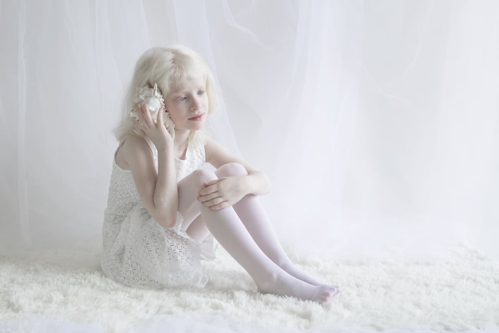 Albinism Photographs | Yulia Taits